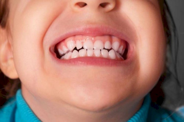 أعراض وأسباب الجز على الأسنان
