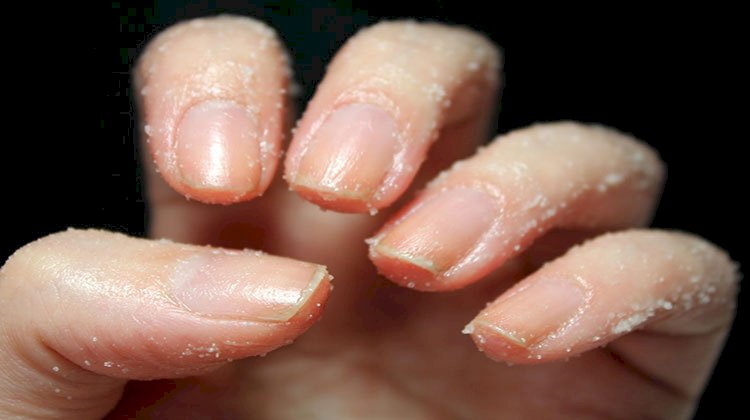 كيفية التخلص من الجلد الميت المتراكم حول الأصابع