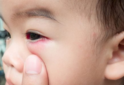 علامة بعيون طفلك تشير إلى مرض خطير