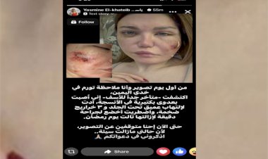 جراحة دقيقة .. ياسمين الخطيب تعلن إصابتها بعدوى بكتيرية في أنسجة بشرة الوجه