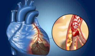 القاتل الصامت في صدرك.. حسام موافي يحذر من ضيق الشريان التاجي