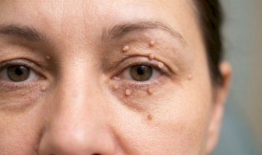 الزوائد الجلدية حول العين..الأسباب ووصفات طبيعية علاجية