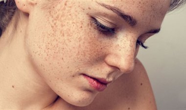 النمش في الصيف.. الأسباب الحقيقية لزيادة ظهوره وطرق الوقاية منه