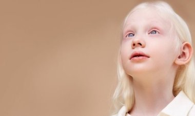 اليوم العالمي لمرض المهق.. اضطراب وراثي يؤثر على الجلد والرؤية