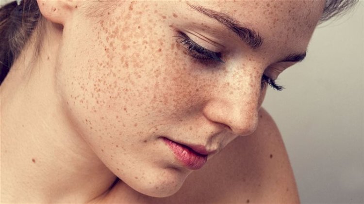 النمش في الصيف.. الأسباب الحقيقية لزيادة ظهوره وطرق الوقاية منه