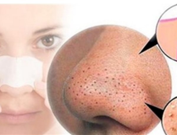 التخلص من الرؤوس السوداء.. 5 طرق لبشرة أكثر نقاءً